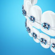 5 tipuri de brățări dentare și plusurile lor