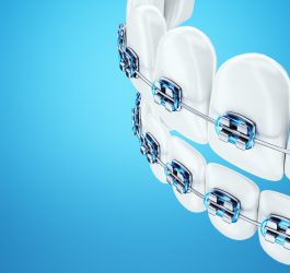 5 tipuri de brățări dentare și plusurile lor